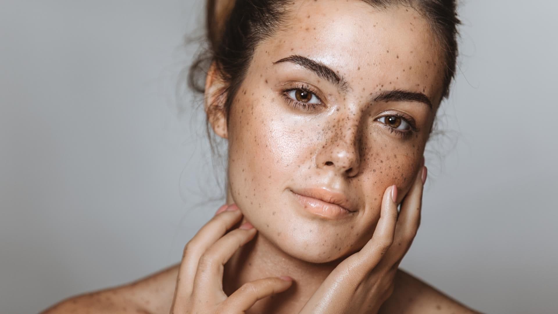 sommersprossen-bekommen-so-gehts-quer sommersprossen-bekommen-so-gehts-quer